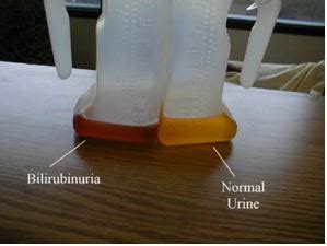 bilirubina 1 in urina|What Bilirubin in Urine Means: Causes, Symptoms